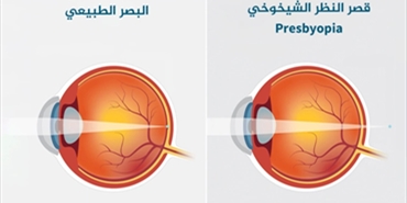 قطرة عين تغني المصابين بقصر النظر الشيخوخي عن نظارات القراءة